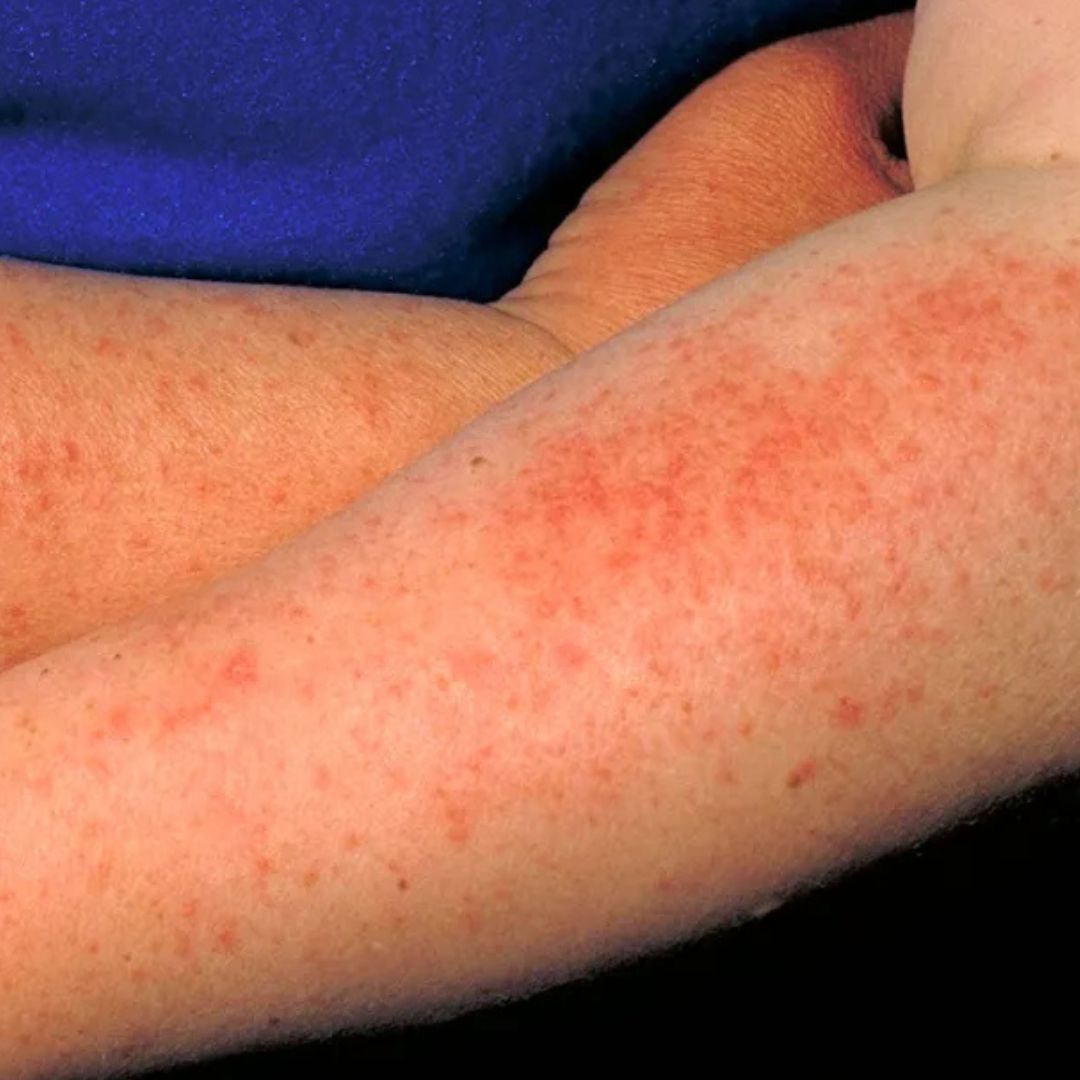 Alergia na slnko1